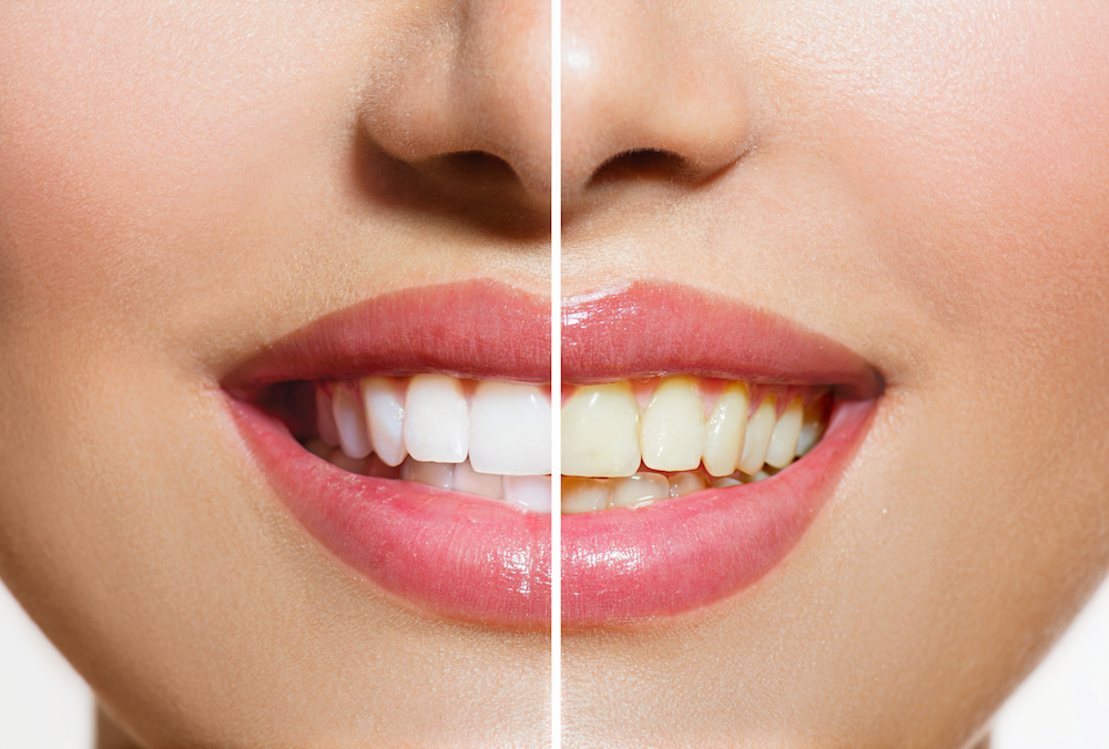 Stained Teeth | Dentist Hartington NE